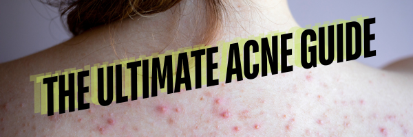 The Ultimate Guide to Acne: Causes, Formation, and Skin Effects